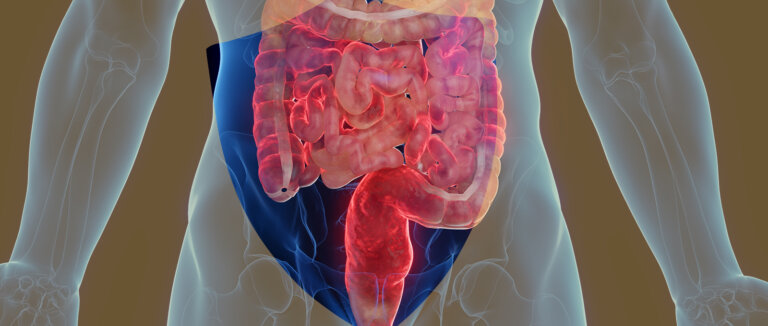 Morbus Crohn